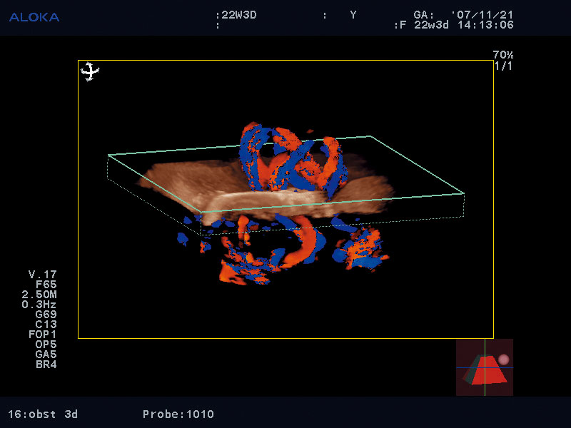 3D реконструкция кровотока (Flow 3D)